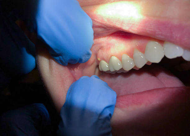 Best Dental Abscess Treatment in South Berwick, ME